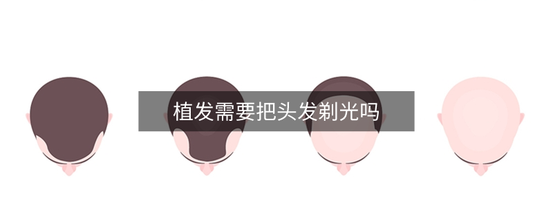 植發(fā)需要把頭發(fā)剃光嗎
